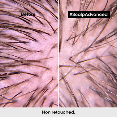 Scalp Advanced Anti-Discomfort Shampoo - L'Oréal Professionnel | L'Oréal Partner Shop
